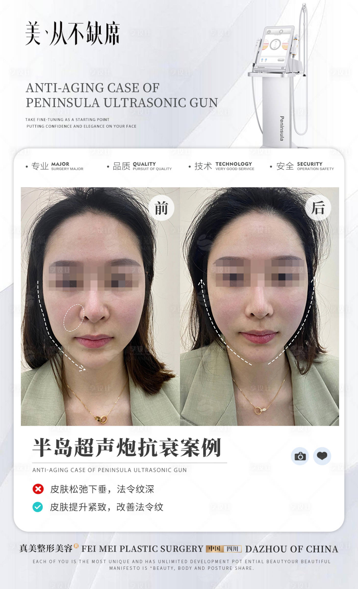 源文件下載【享設(shè)計(jì)】搜索編號(hào)：22410024194917100【醫(yī)美超聲炮案例宣傳海報(bào)】