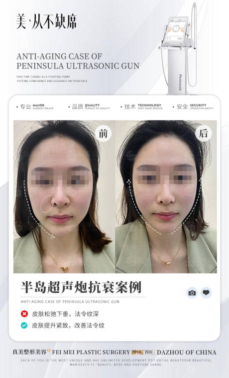 编号：22410024194917100【享设计】源文件下载-医美超声炮案例宣传海报