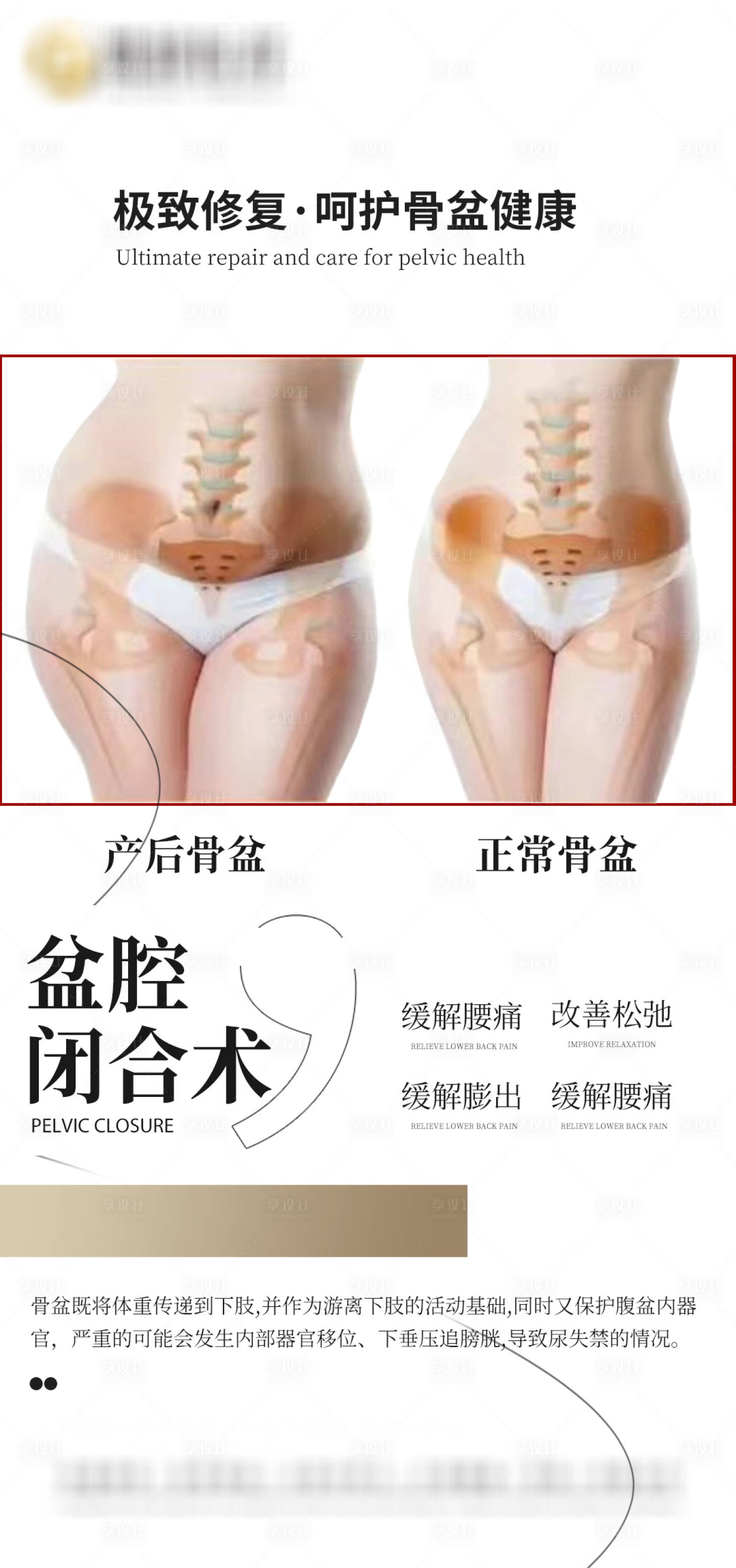 源文件下载【享设计】搜索编号：84880024059783583【盆骨闭合术宣传海报】