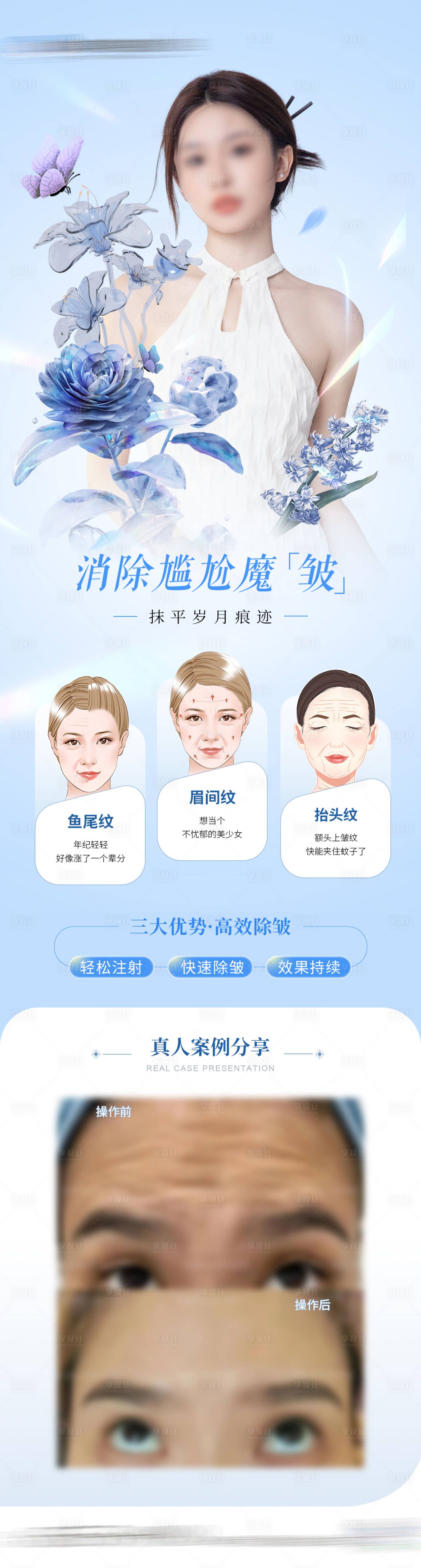 源文件下載【享設計】搜索編號：28080023878786196【醫美除皺針案例海報】