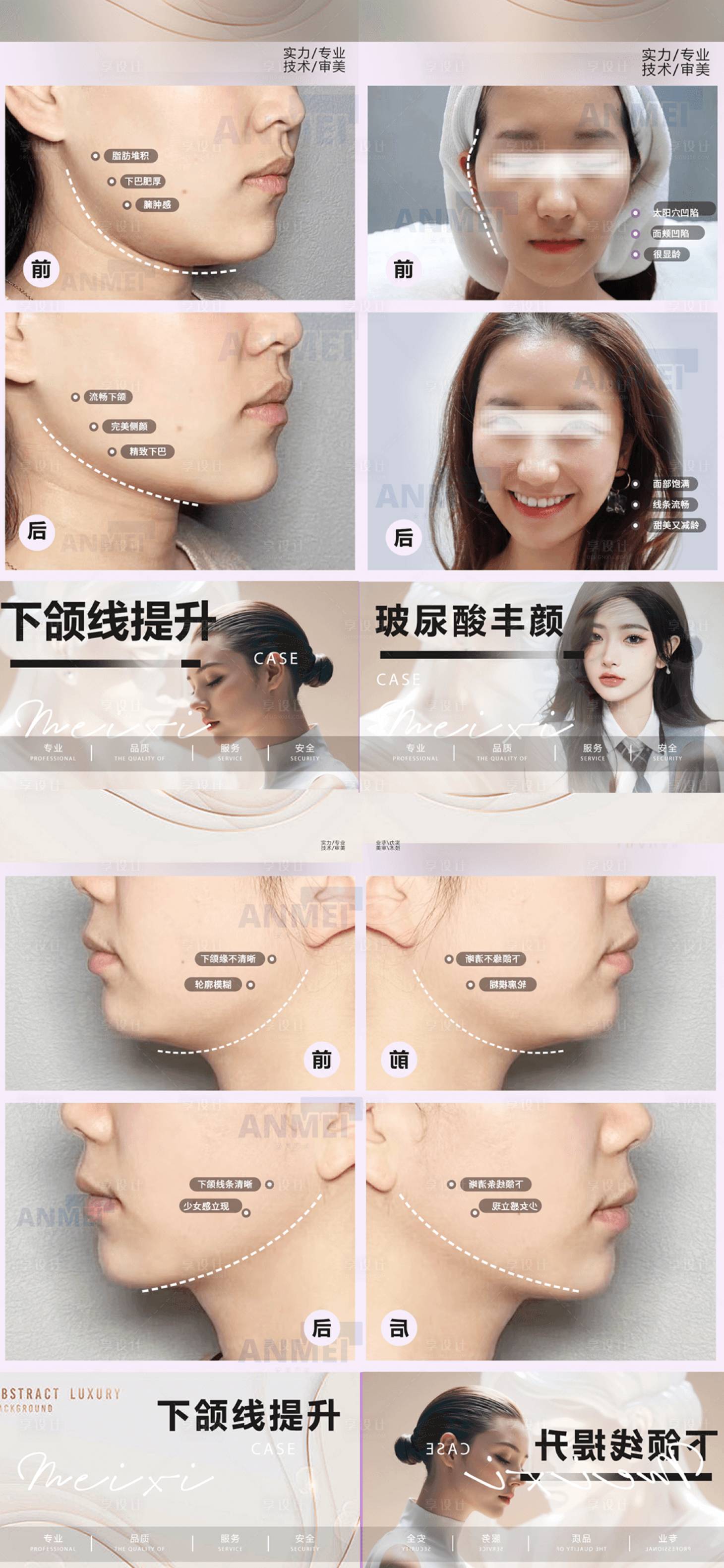 源文件下载【享设计】搜索编号：23200023881365930【医美玻尿酸案例对比海报】