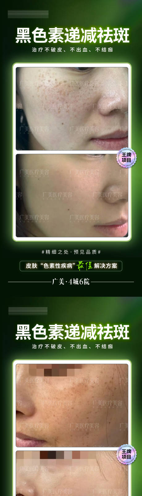 源文件下載【醫(yī)美祛斑案例對比海報】編號：28290023832752894