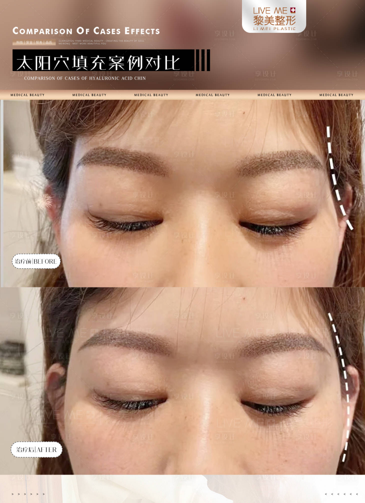 源文件下载【太阳穴填充案例海报】编号：50310023973957378