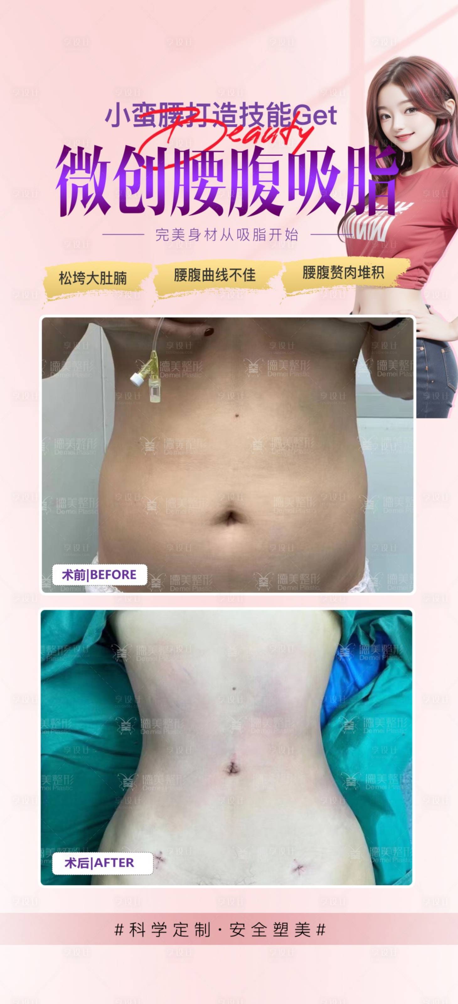 源文件下载【腰腹吸脂案例】编号：83250024318581972