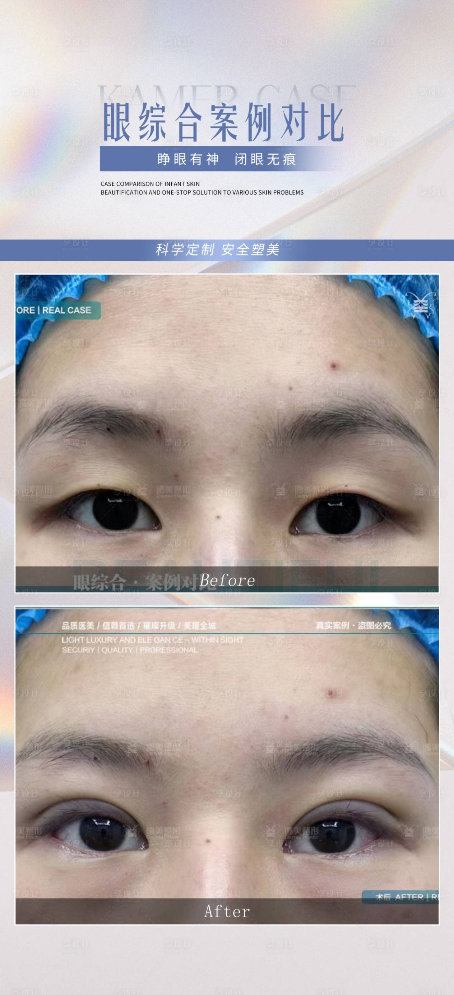 源文件下载【享设计】搜索编号：56770024264737958【医美眼综合案例】