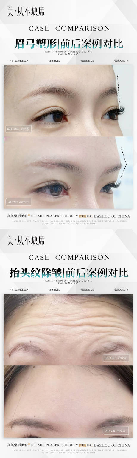 源文件下載【享設(shè)計(jì)】搜索編號：33790024712631690【抬頭紋除皺眉弓案例】