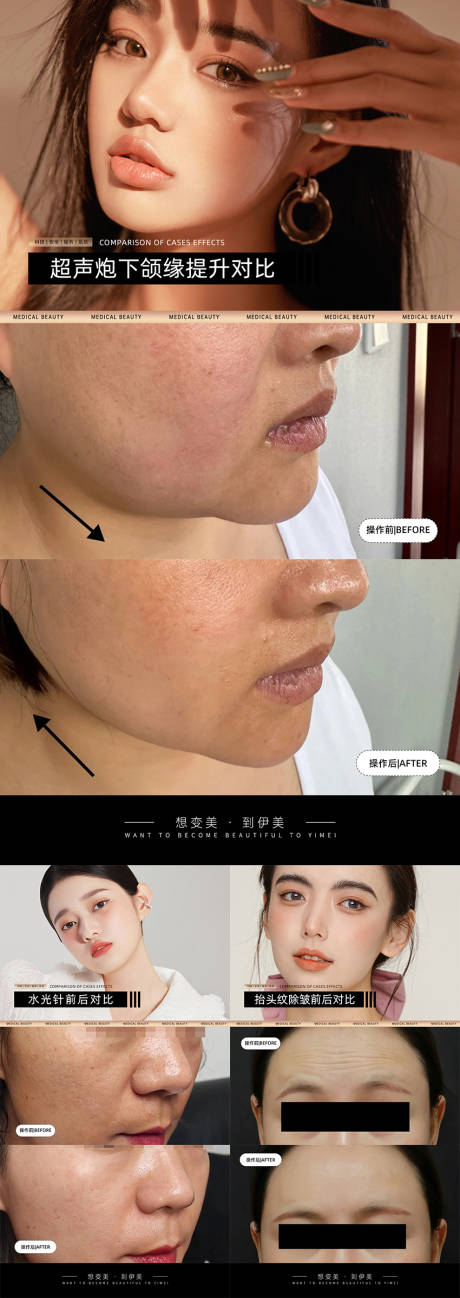 源文件下载【享设计】搜索编号：44810024321515012【医美案例对比模板】