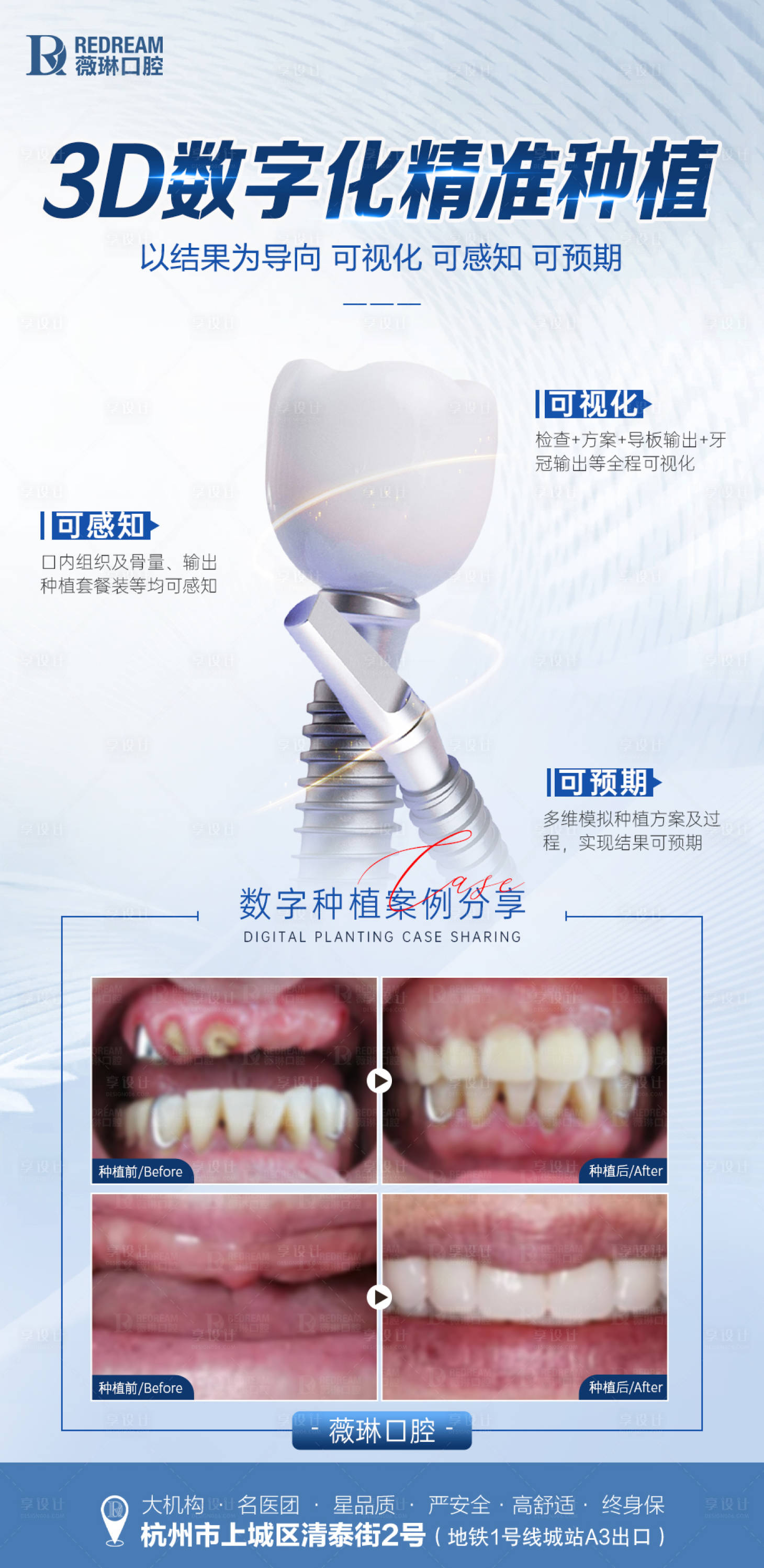 源文件下载【享设计】搜索编号：99960024785622415【数字化种植牙】
