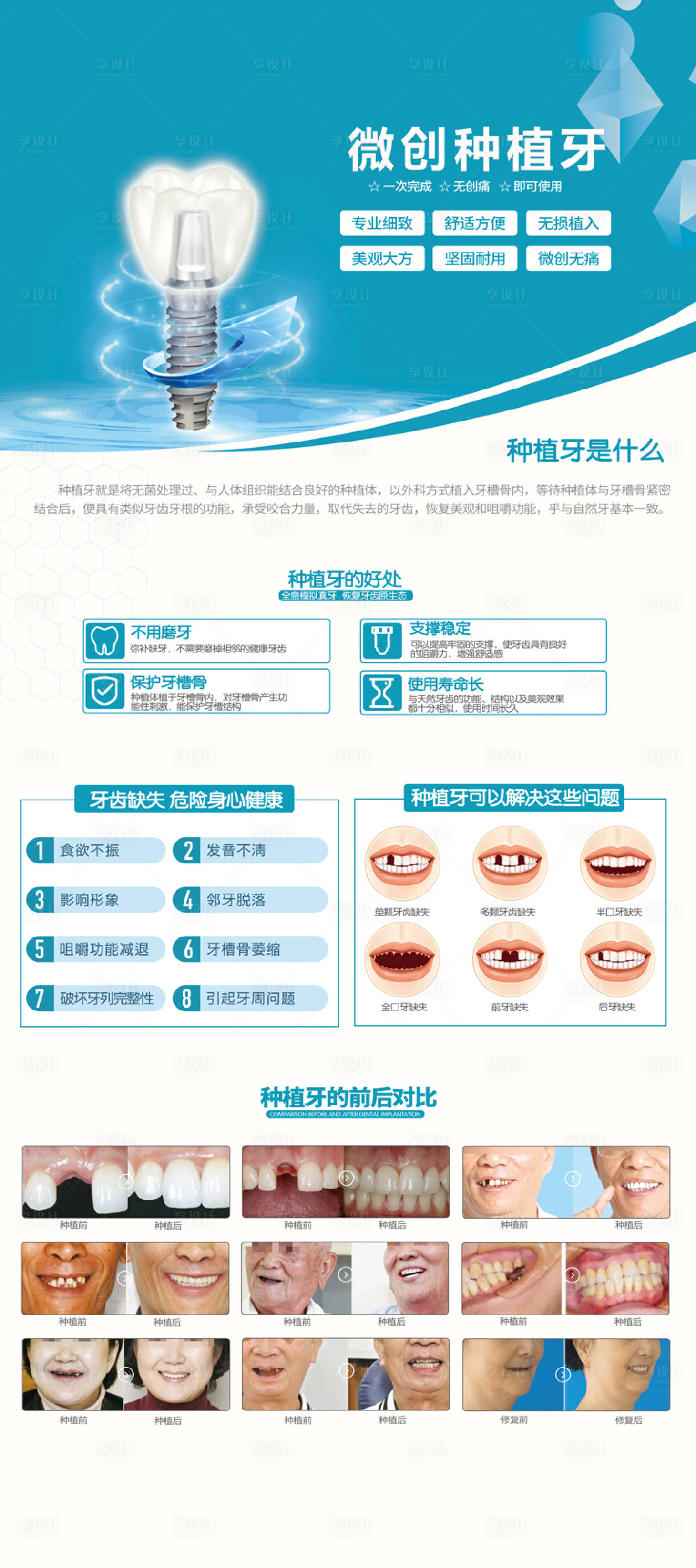 源文件下載【享設(shè)計(jì)】搜索編號(hào)：79810024343634815【醫(yī)美口腔微創(chuàng)種植牙】