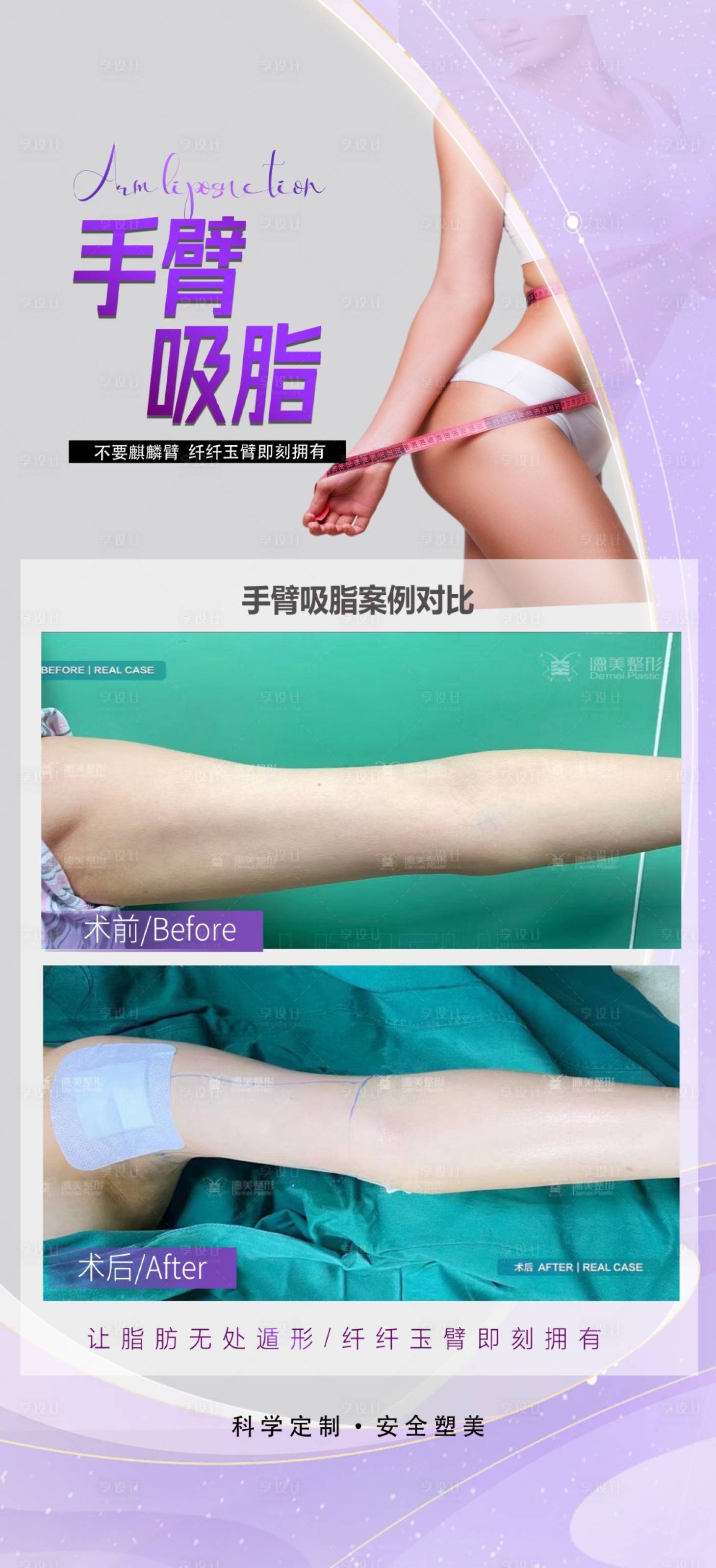 源文件下载【享设计】搜索编号：44830024792964410【手臂吸脂案例海报】