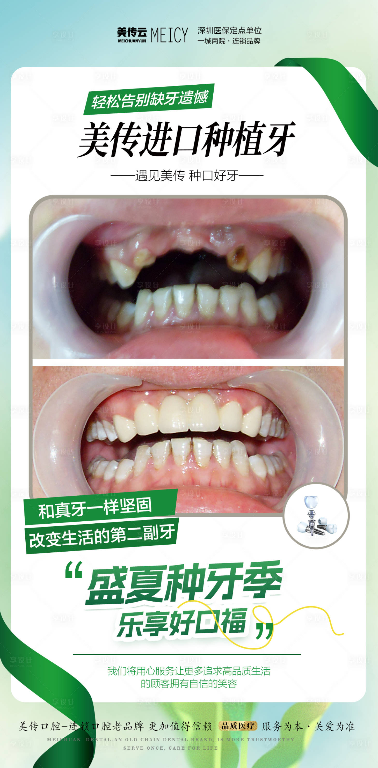 源文件下载【享设计】搜索编号：89630024479178852【口腔种植牙案例对比海报】