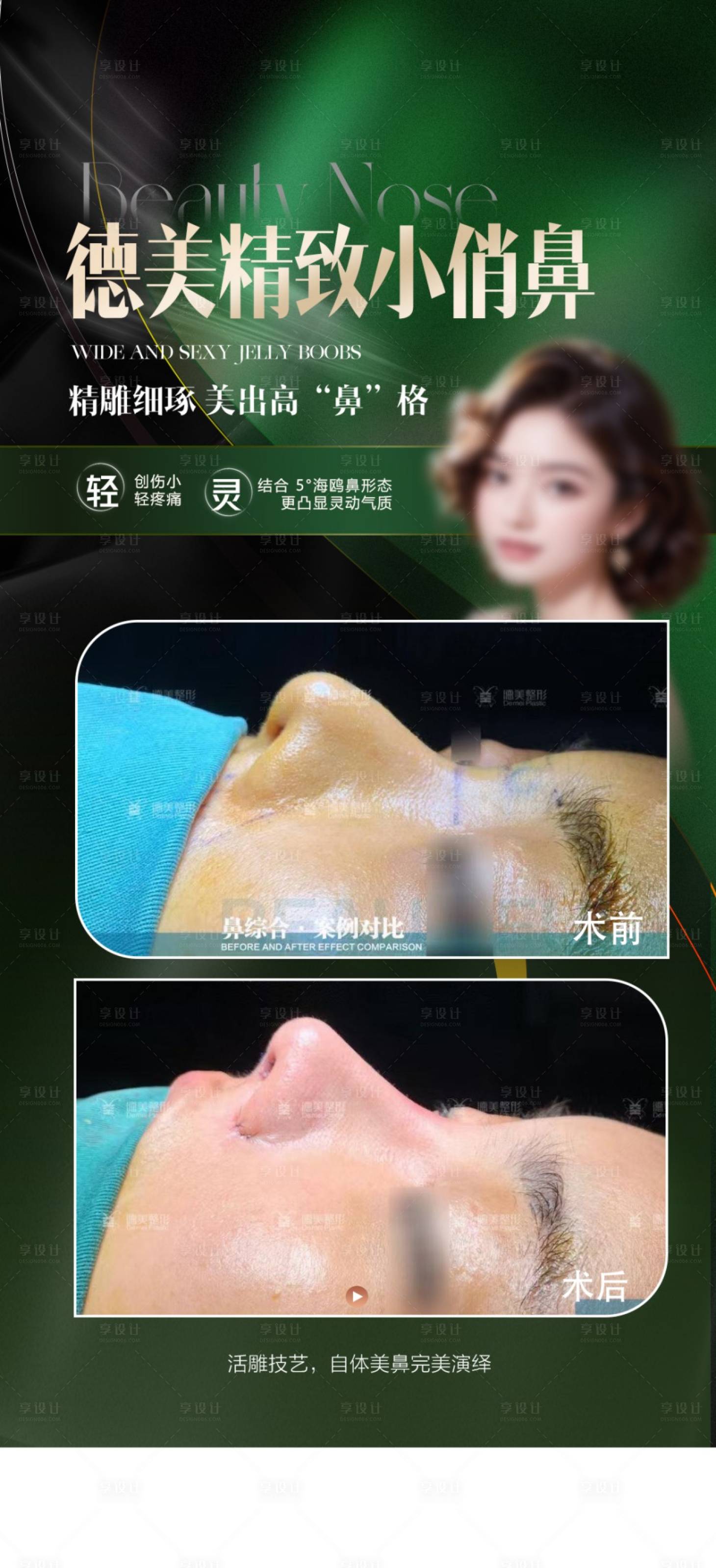 源文件下载【享设计】搜索编号：42260024716367135【鼻综合案例海报】