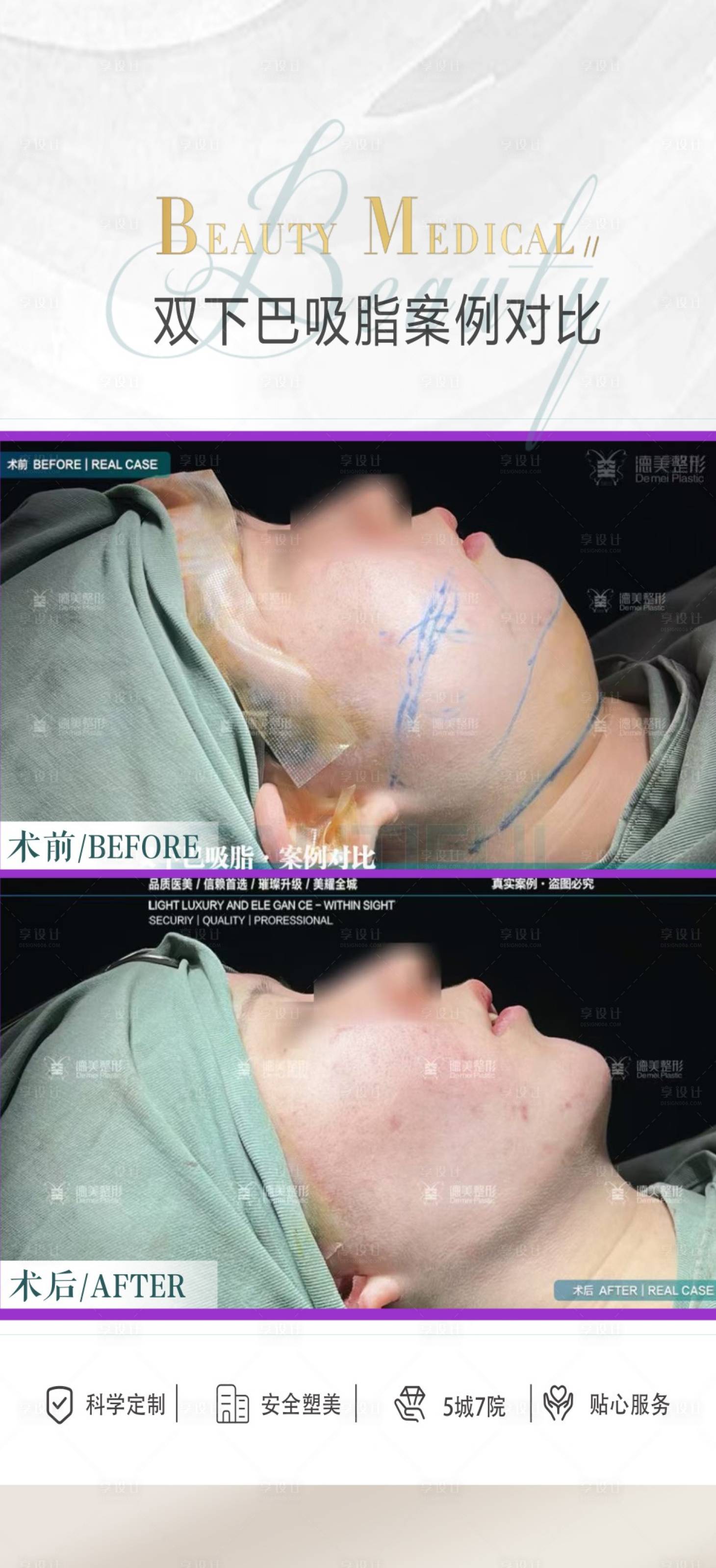 源文件下载【享设计】搜索编号：60030024264477826【医美双下巴吸脂案例海报】