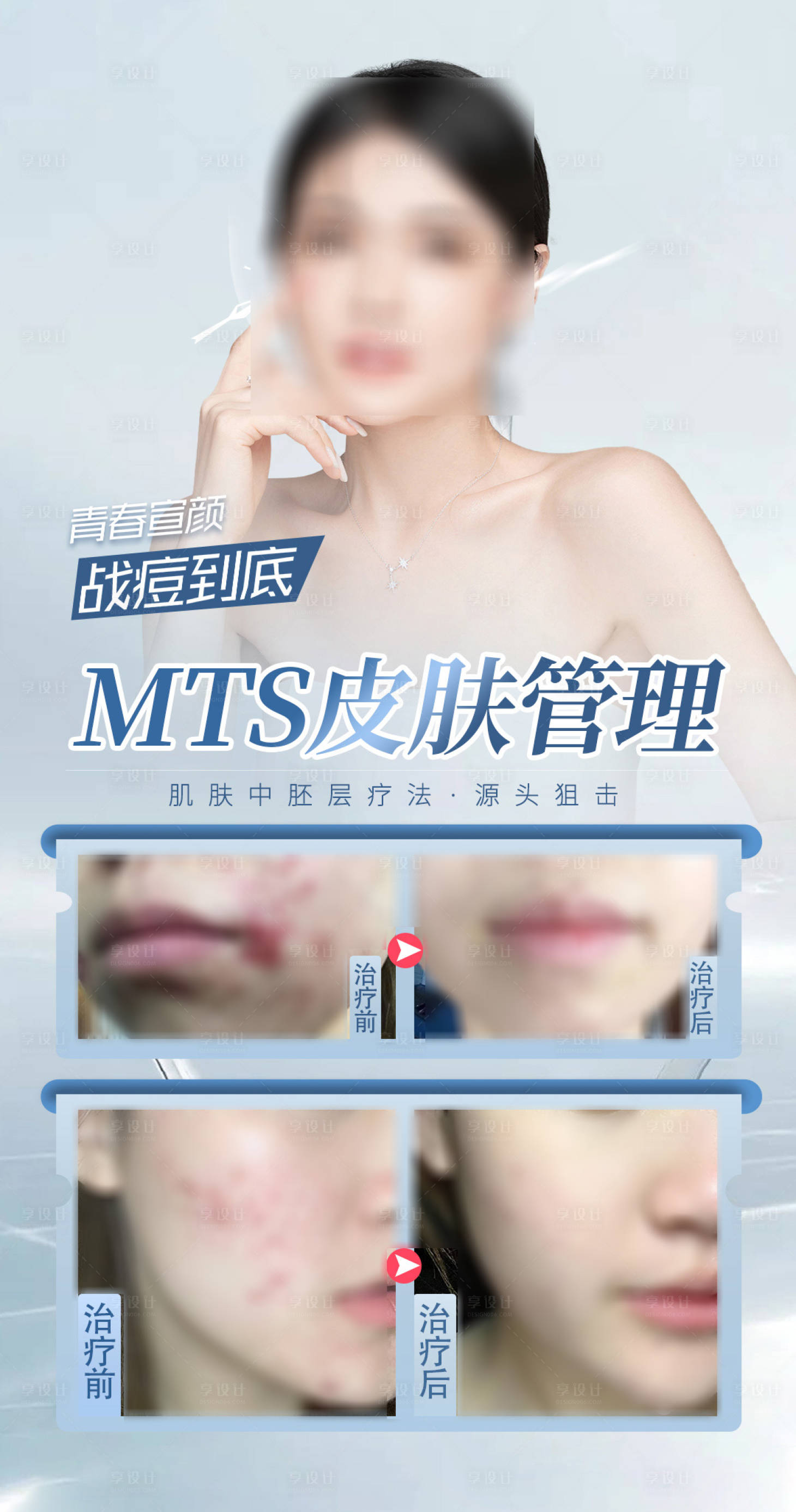 源文件下載【享設計】搜索編號：58600024701118653【mts皮膚管理祛痘】