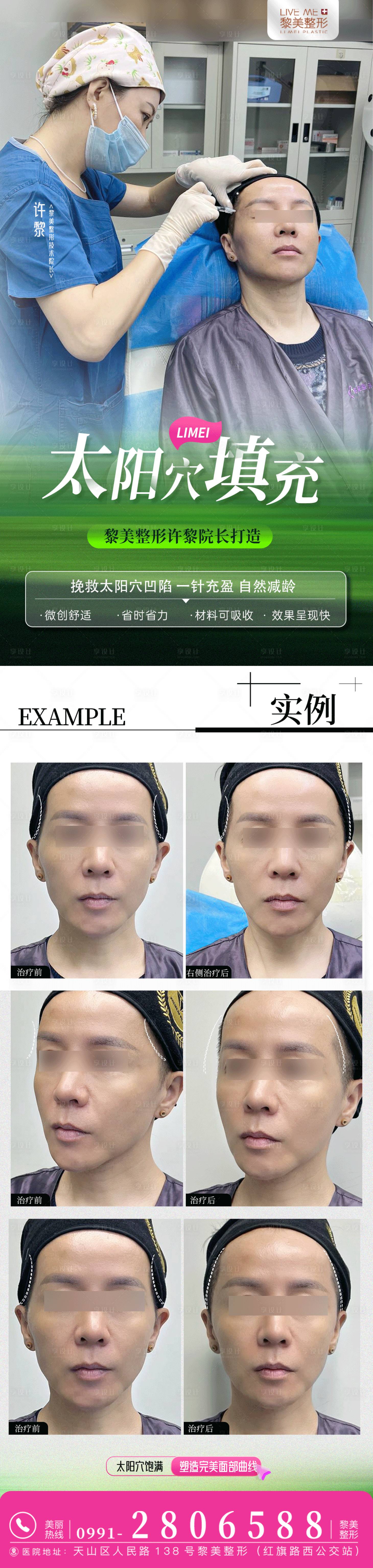 源文件下载【太阳穴填充案例 】编号：49340024755249650