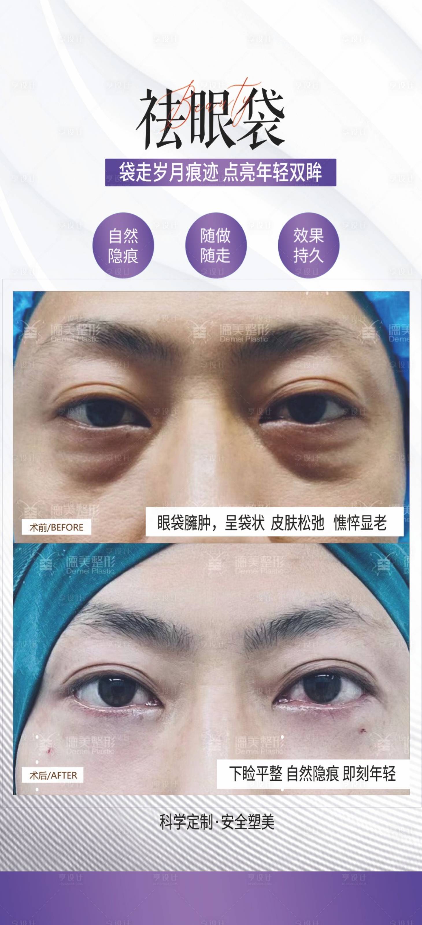 源文件下载【享设计】搜索编号：89040024426208264【祛眼袋案例海报】