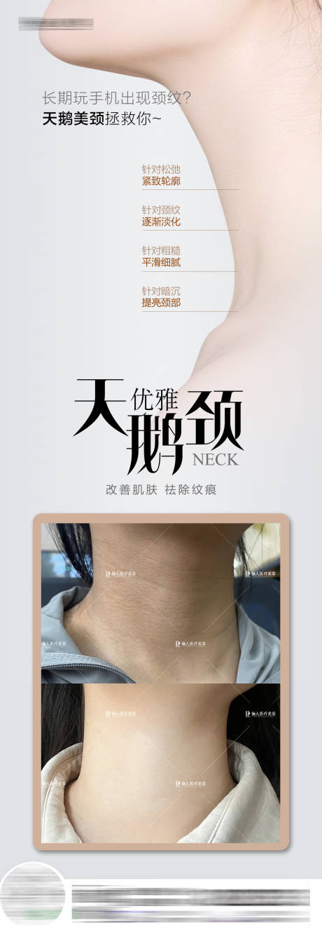 源文件下载【享设计】搜索编号：57930024561552647【医美天鹅颈祛颈纹案例长图】