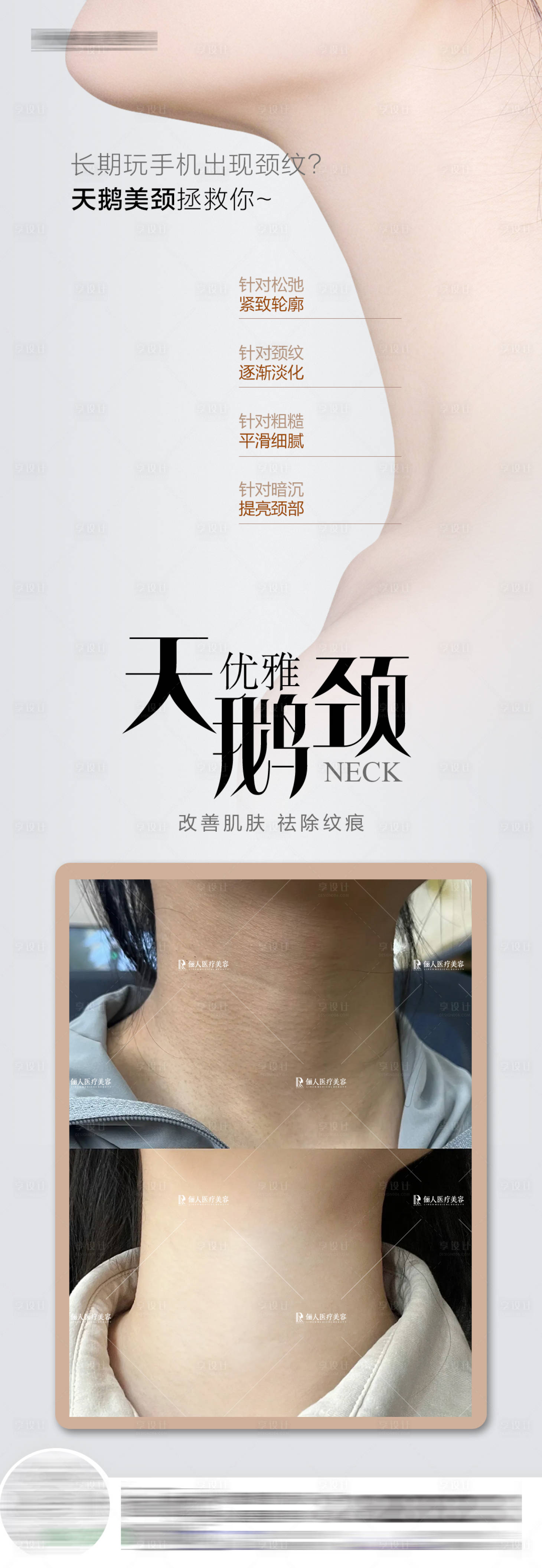 源文件下載【享設計】搜索編號：57930024561552647【醫美天鵝頸祛頸紋案例長圖】