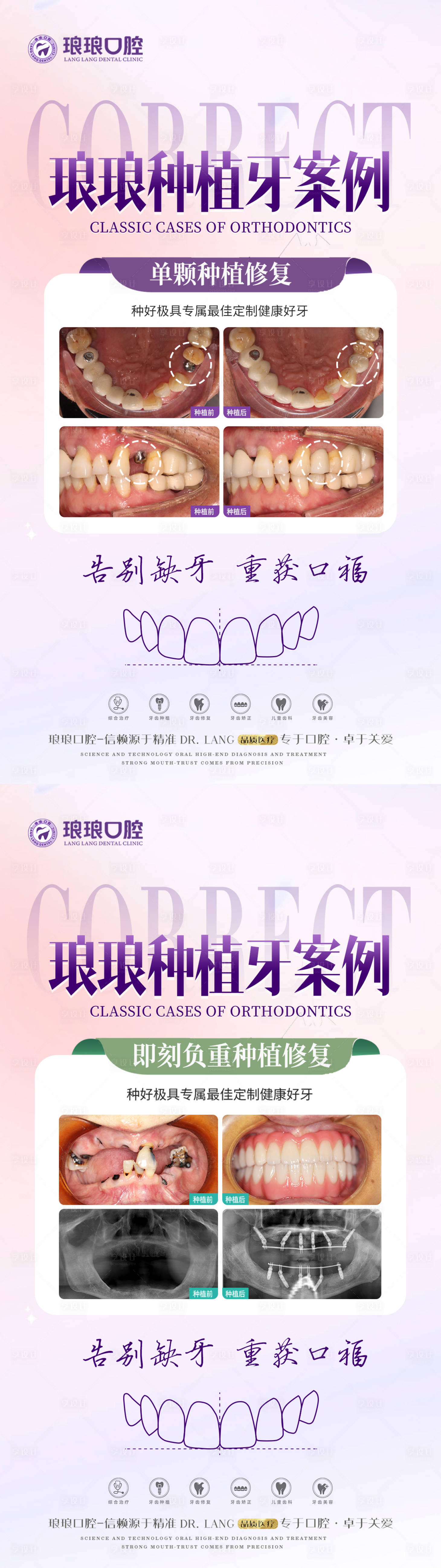 源文件下載【享設計】搜索編號：70240025252156969【口腔種植牙案例海報】