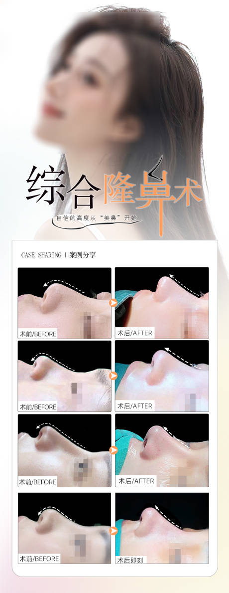 源文件下載【隆鼻真人案例醫美整形項目海報】編號：98410025423532530