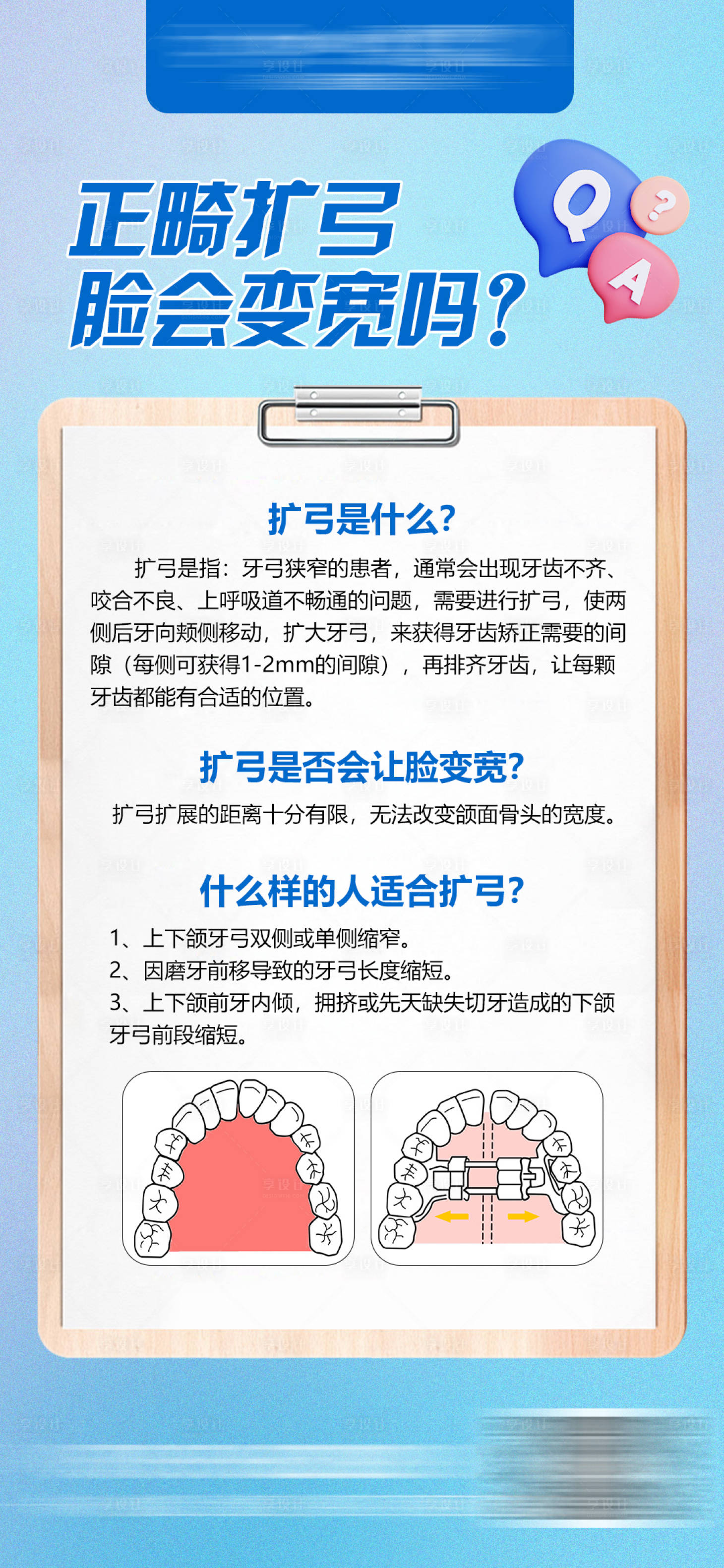 源文件下載【享設計】搜索編號：71910025375695440【正畸擴弓科普海報】