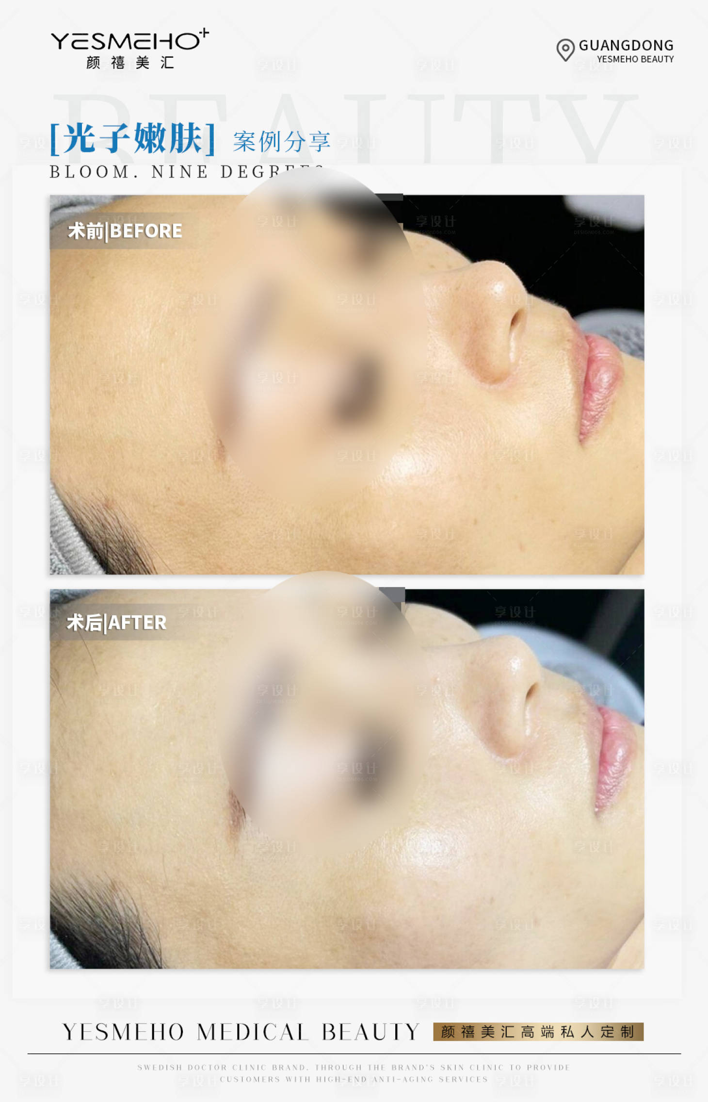源文件下载【享设计】搜索编号：70650024870227540【光子嫩肤案例海报】