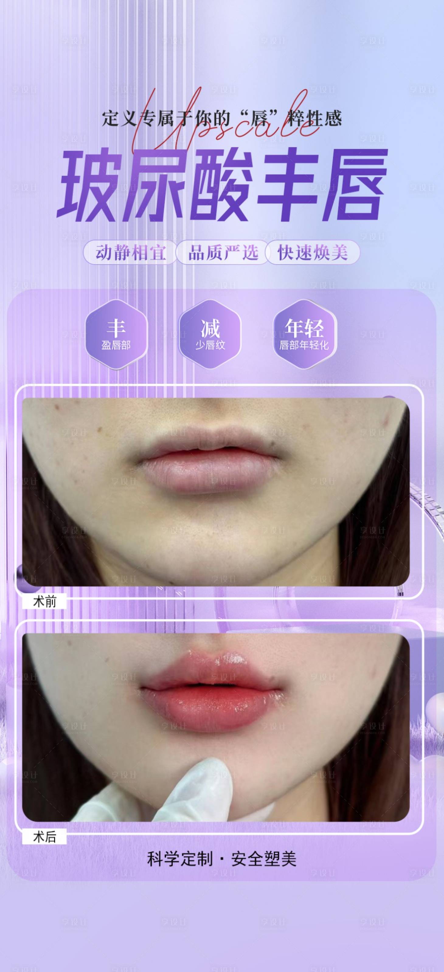 源文件下載【享設(shè)計】搜索編號：95090025137737754【玻尿酸豐唇案例海報】