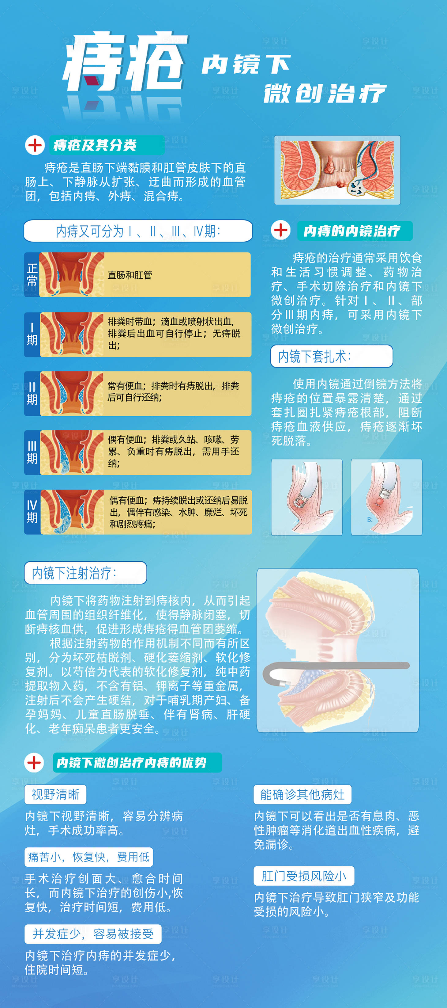源文件下載【享設計】搜索編號：11700025685829120【痔瘡內鏡治療微創海報】