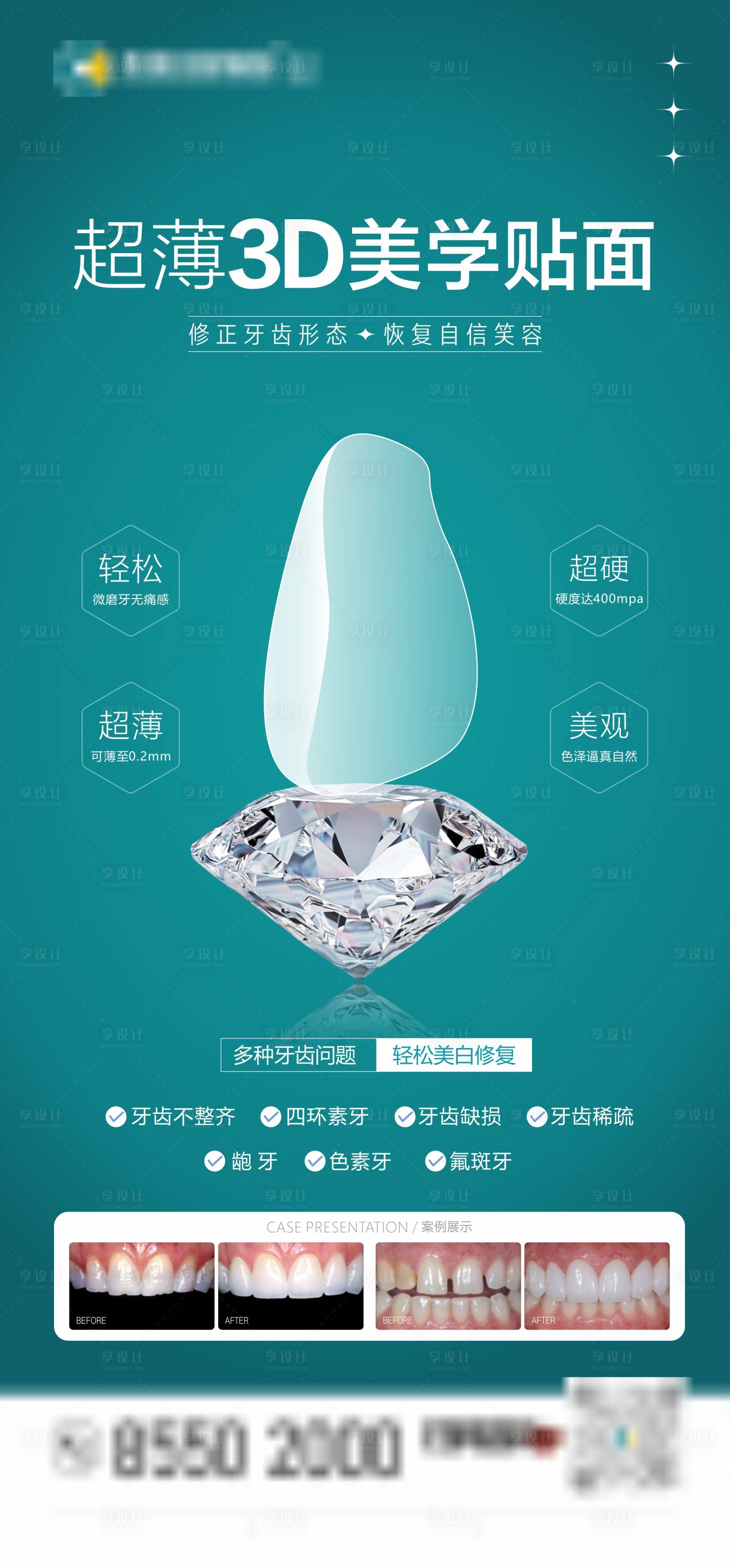 源文件下載【享設計】搜索編號：61470025920706942【口腔美學貼面海報】