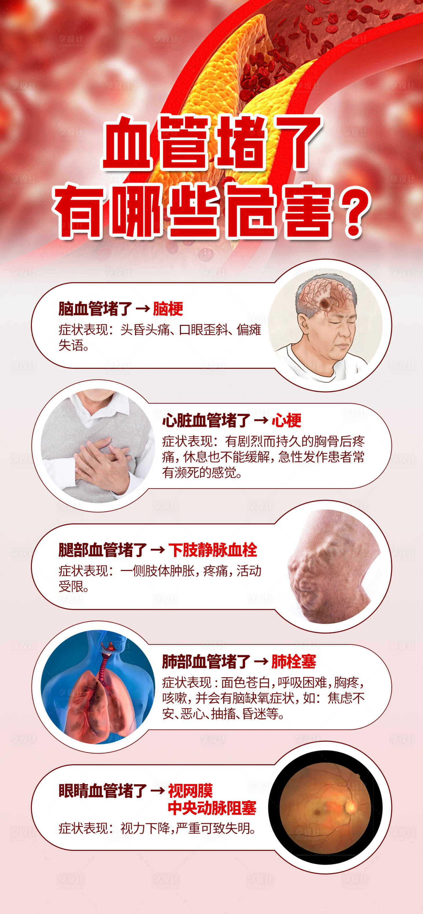 源文件下載【享設計】搜索編號：52240026011923133【血管堵了有那些危害宣傳海報】