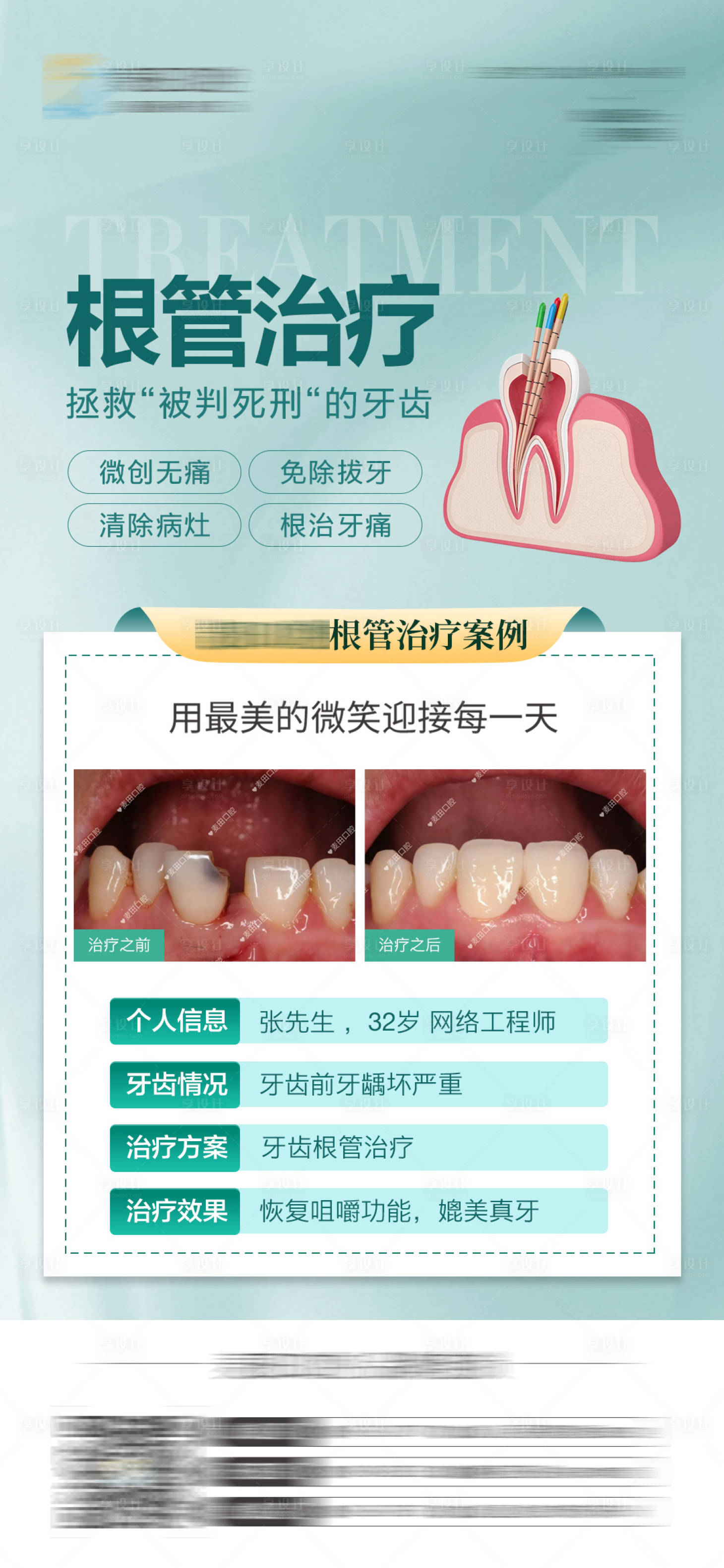 源文件下載【享設計】搜索編號：93090025746868454【醫美口腔牙齒根管治療對比海報】