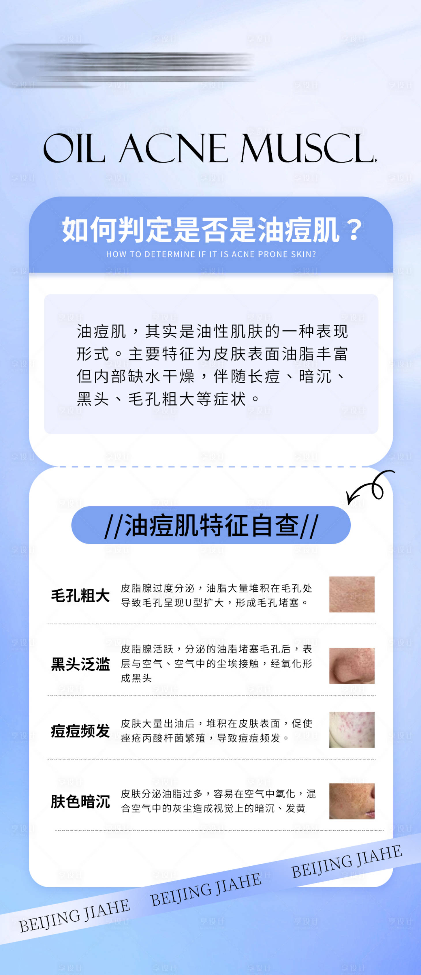 源文件下載【享設計】搜索編號：42060025712446911【油痘肌科普海報】
