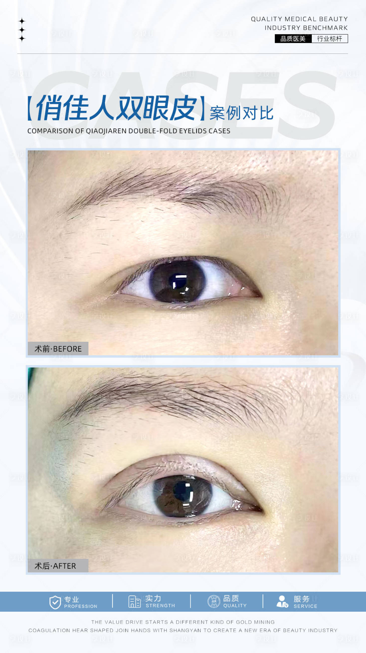 源文件下载【享设计】搜索编号：69400026209847671【双眼皮案例海报】
