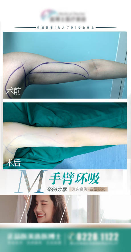 源文件下载【享设计】搜索编号：11090026416388694【医美案例 手臂吸脂】