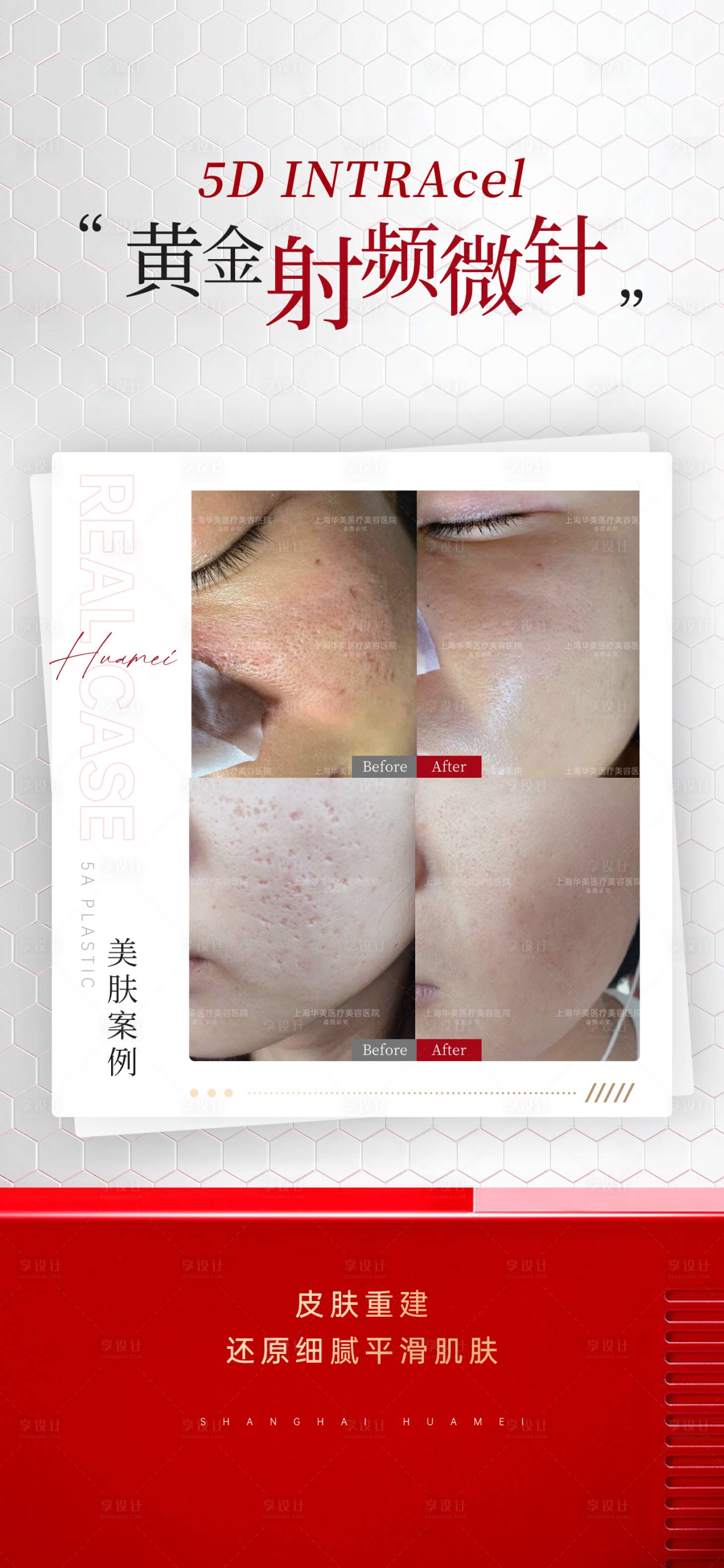 源文件下载【享设计】搜索编号：88520026274562369【医美案例海报】