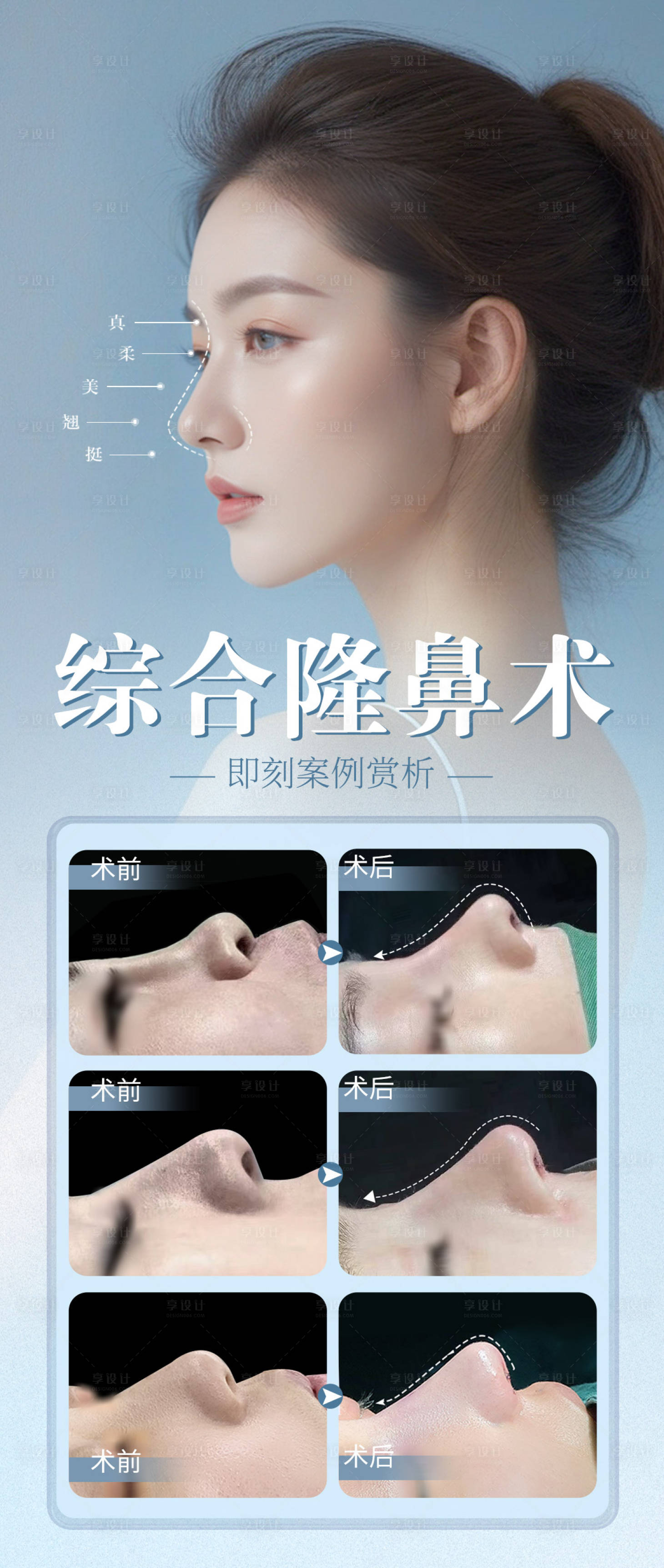 源文件下载【享设计】搜索编号：71930026289769329【隆鼻真人案例医美整形项目】