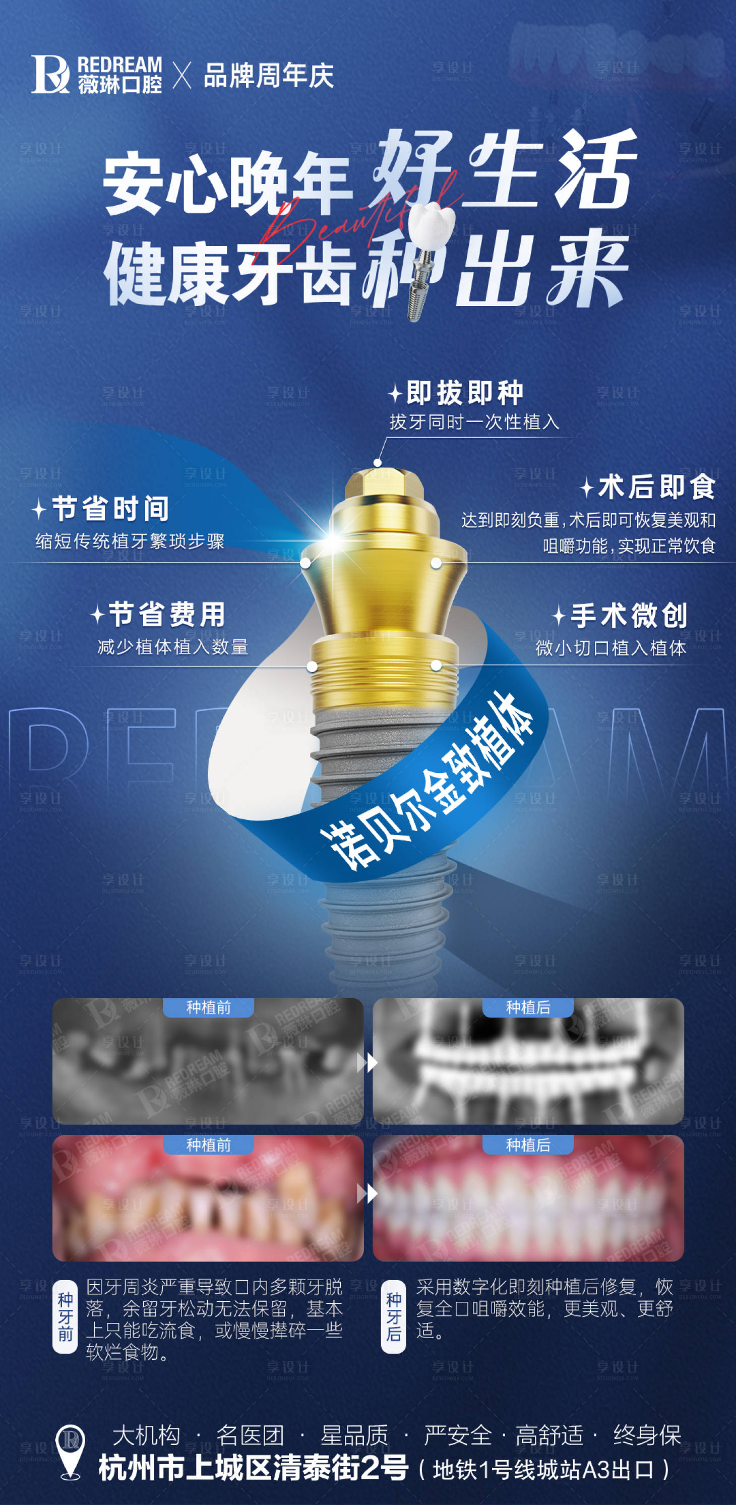 源文件下載【享設計】搜索編號：39070026263831417【種植牙技術(shù)海報】