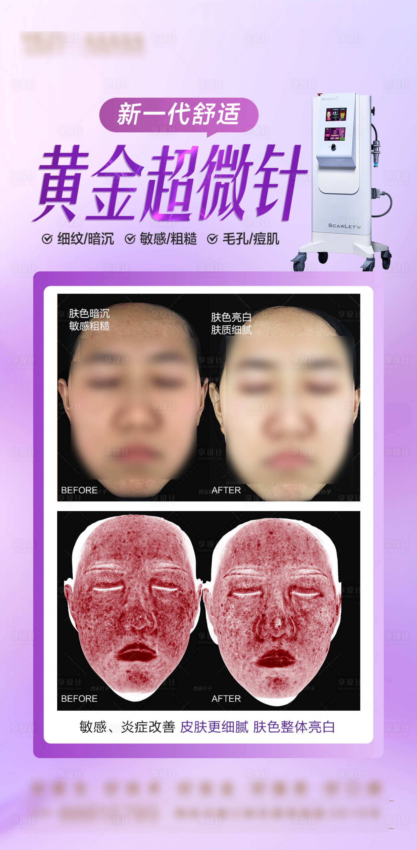 源文件下載【享設計】搜索編號：59770026518228577【黃金微針案例對比海報】