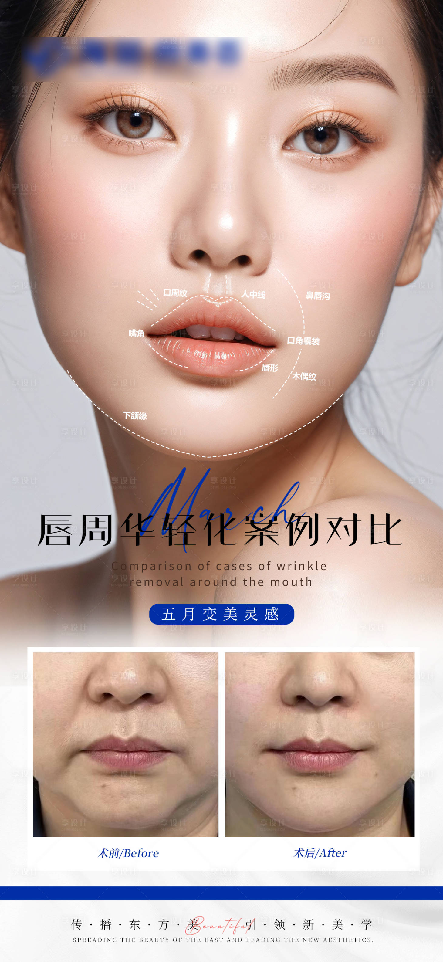 源文件下載【享設(shè)計(jì)】搜索編號(hào)：13690026331927586【醫(yī)美唇周抗衰案例對(duì)比海報(bào)】