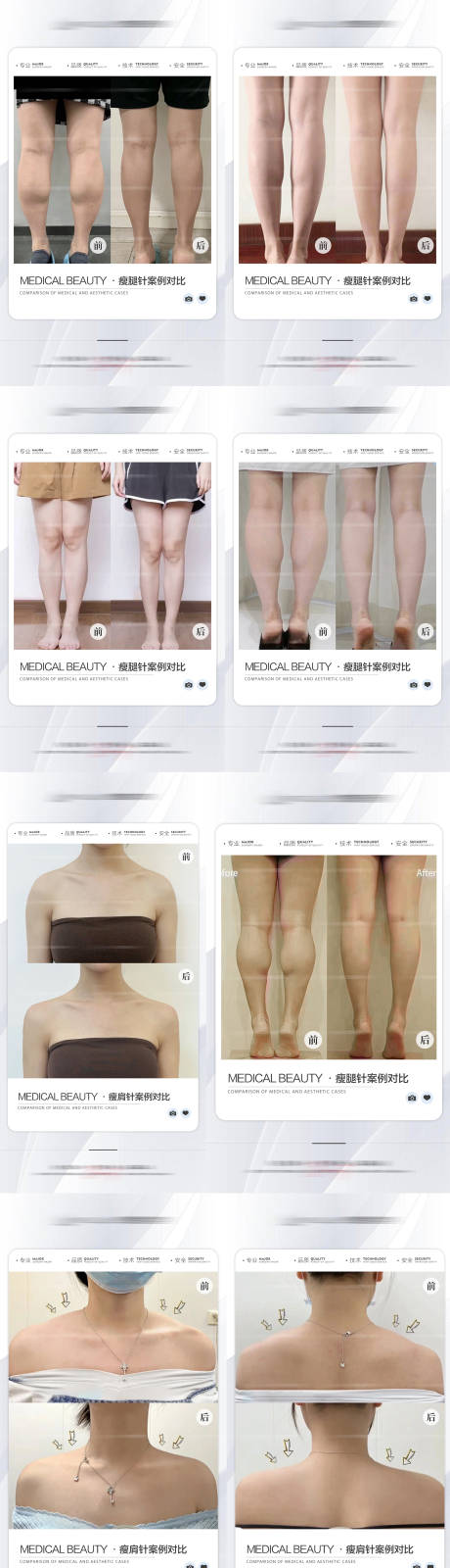 源文件下载【医美瘦腿瘦肩案例对比海报】编号：45240026106345273