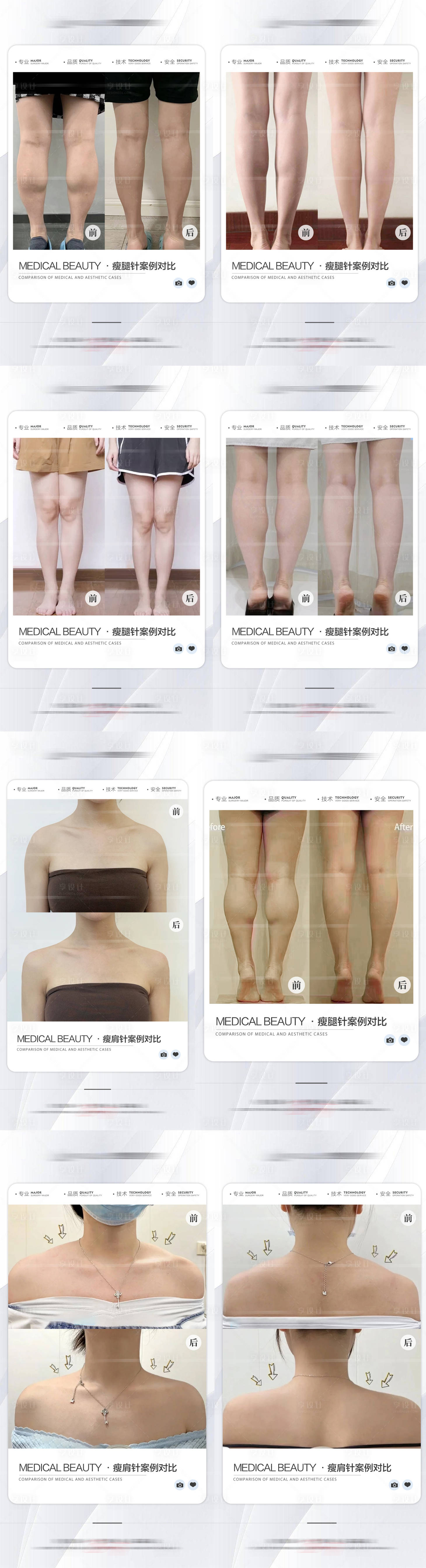 源文件下载【享设计】搜索编号：45240026106345273【医美瘦腿瘦肩案例对比海报】