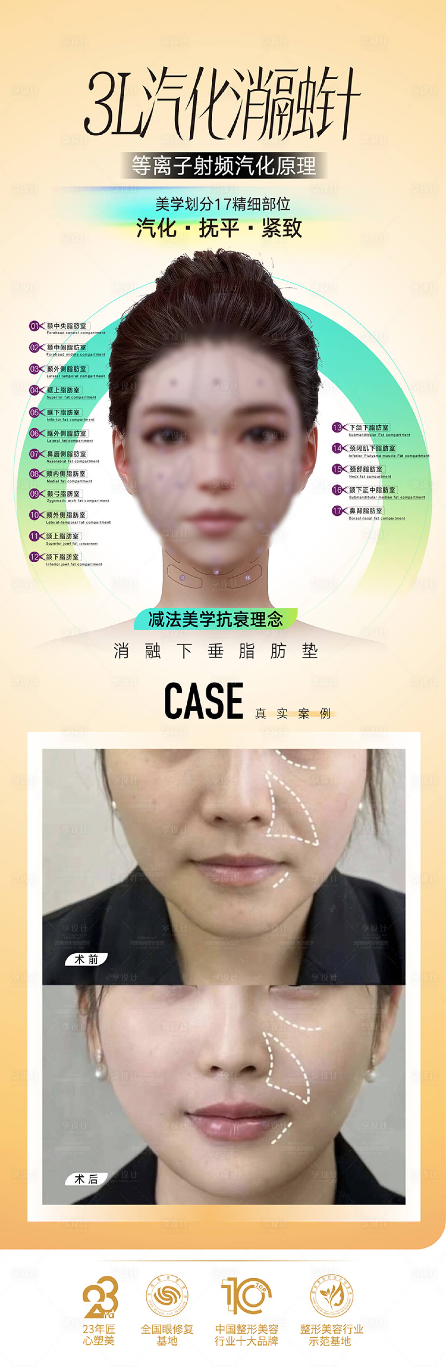 源文件下載【享設計】搜索編號：59210026249301401【醫美消融針長圖海報】
