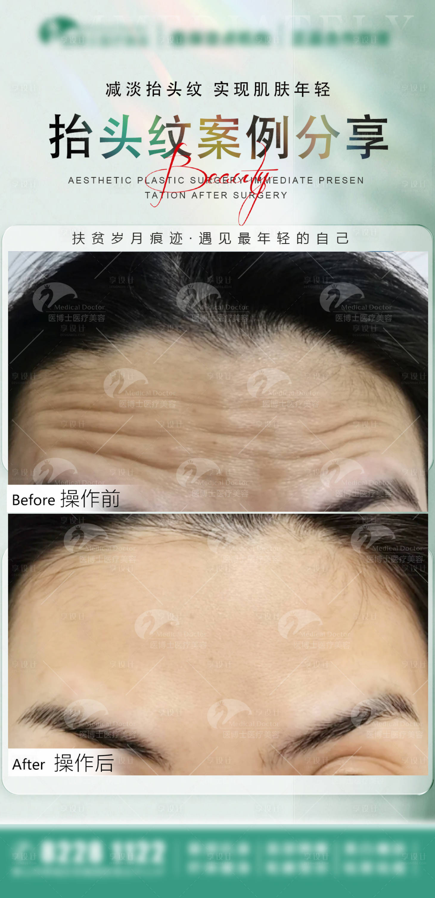 源文件下载【医美案例抬头纹宣传海报】编号：67570026390865779