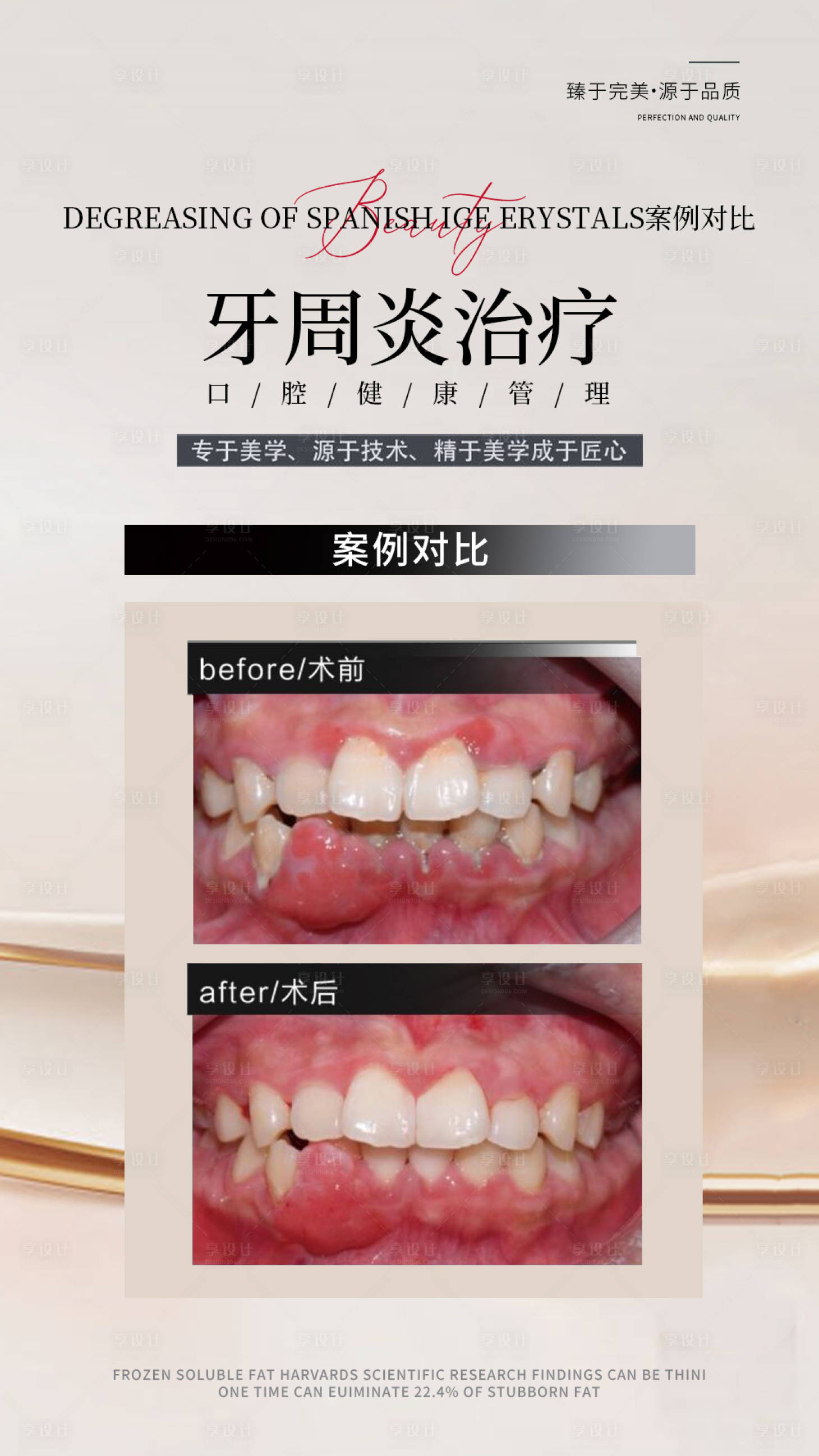 源文件下载【享设计】搜索编号：82640026538048010【牙周炎治疗对比图海报】