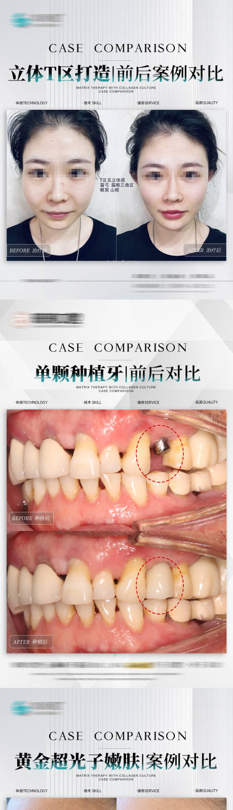 医美整形口腔案例对比系列海报展板