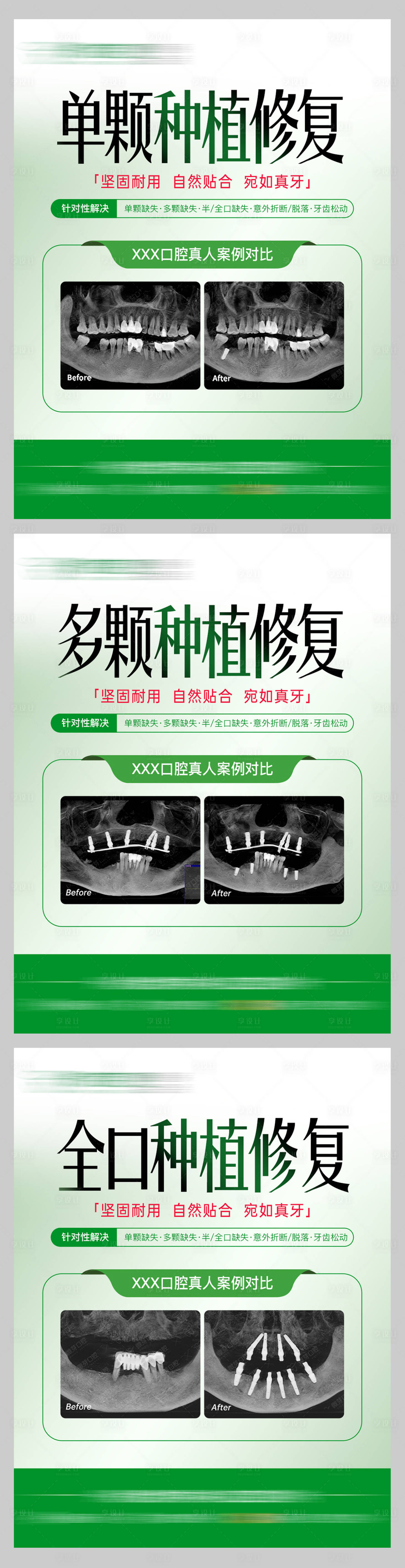 源文件下载【享设计】搜索编号：94880026719635386【口腔种植牙案例】