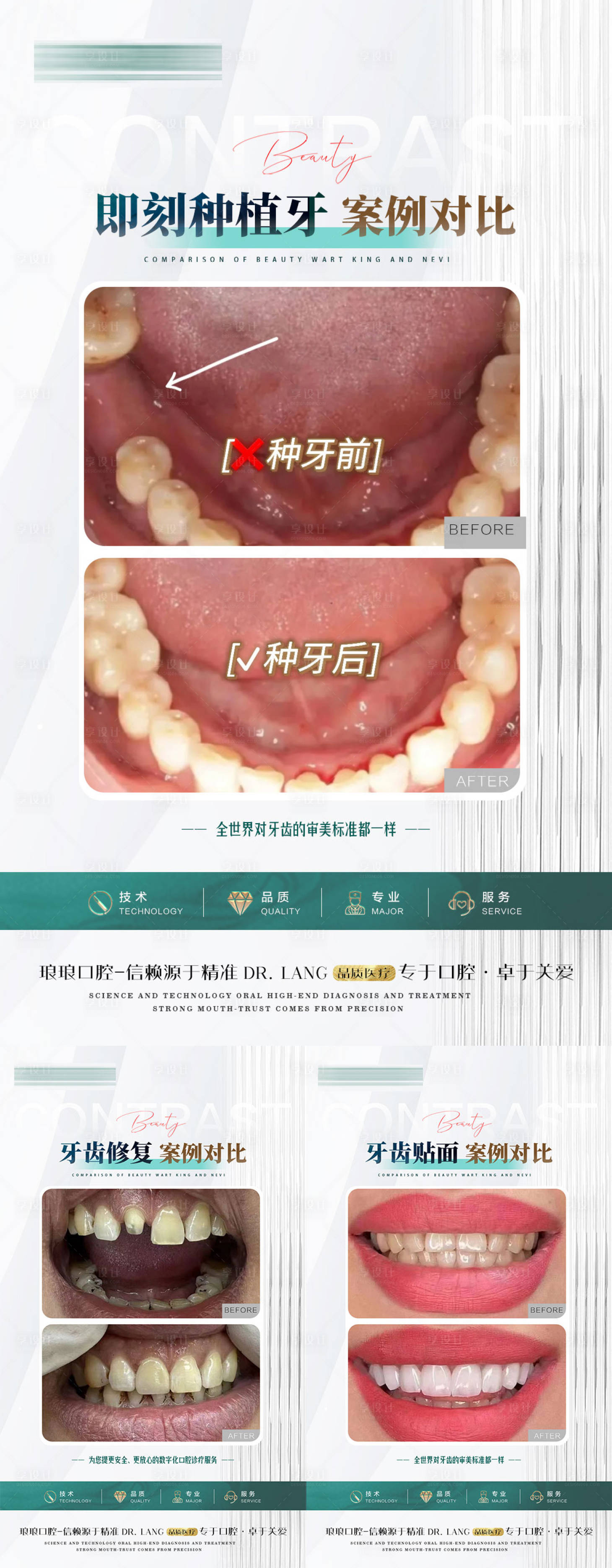 源文件下载【享设计】搜索编号：13180026750653646【口腔贴面种植修复案例】