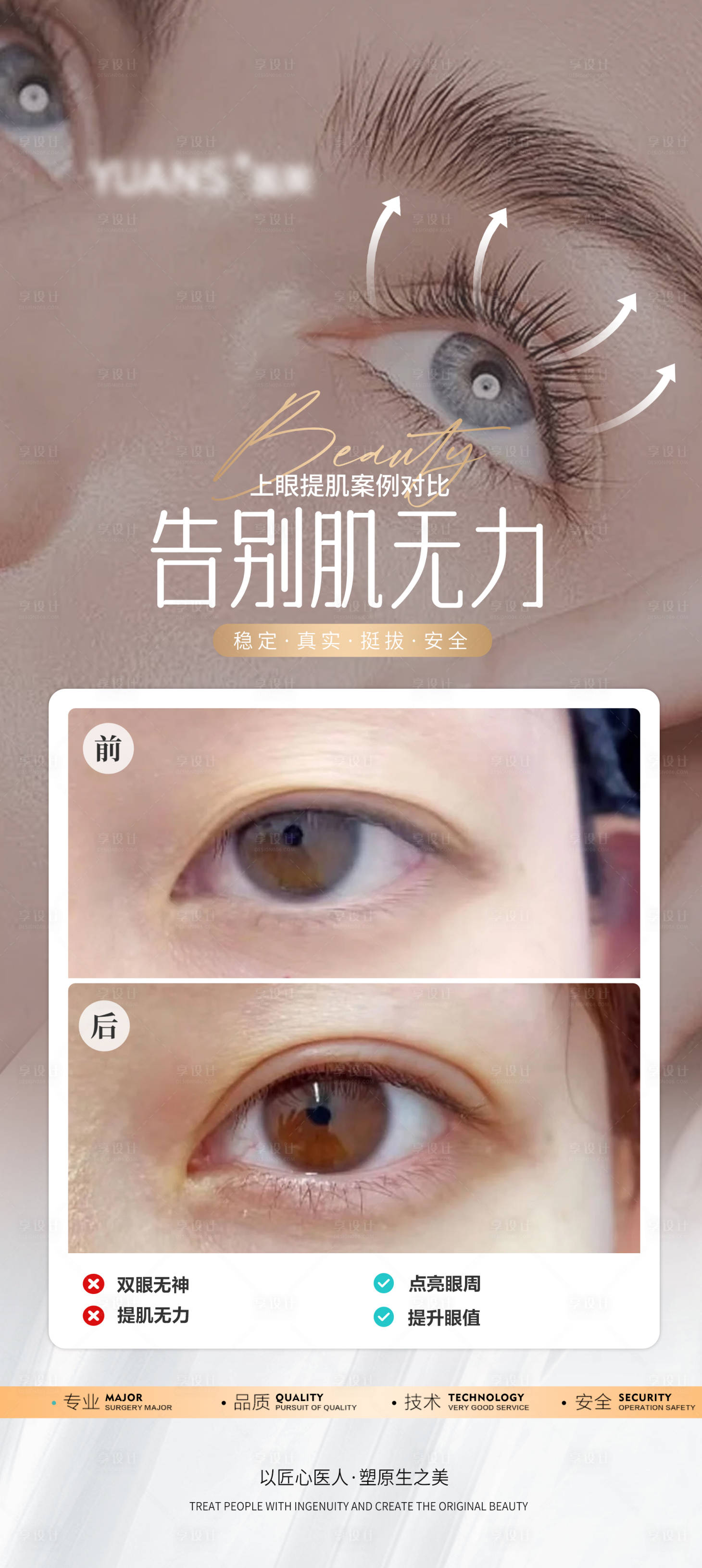 源文件下载【享设计】搜索编号：11800027038262192【医美眼周上眼提肌案例海报】