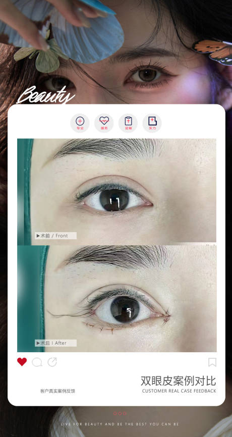 源文件下载【医美双眼皮案例】编号：67560026977673700