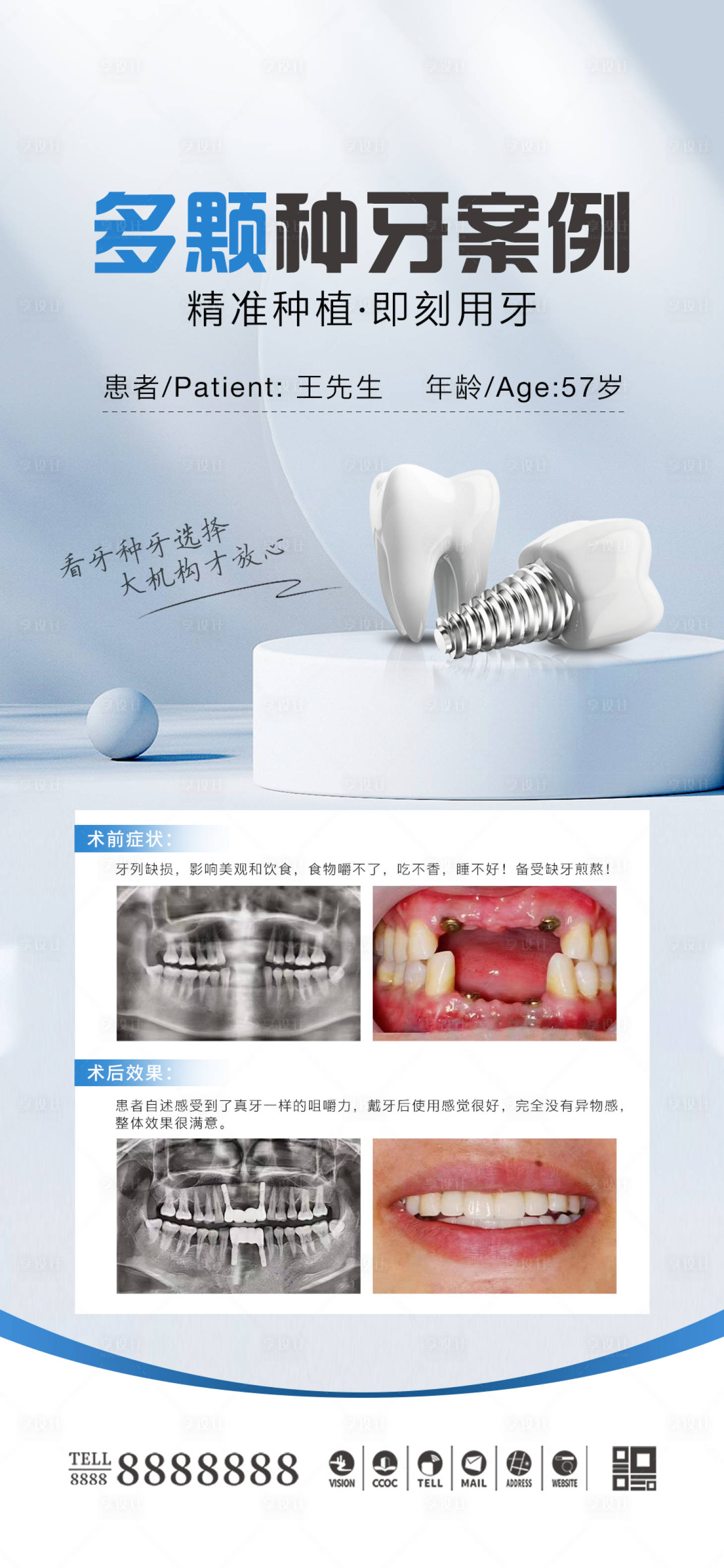 源文件下載【享設計】搜索編號：67300026927895911【口腔種植牙案例海報】
